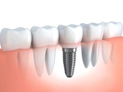 dental implants brampton