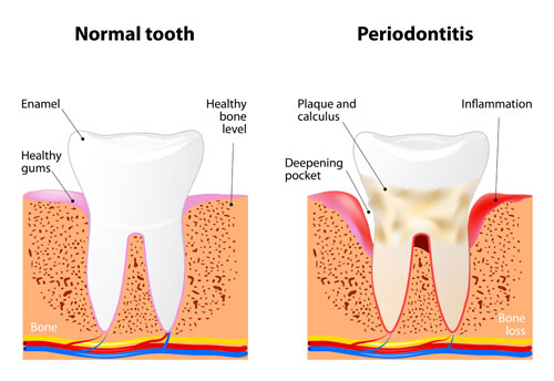 periodontal treatment brampton